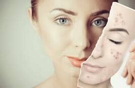 Botox ersetzen